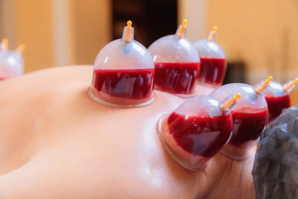 Hijama Wet Cupping Therapy